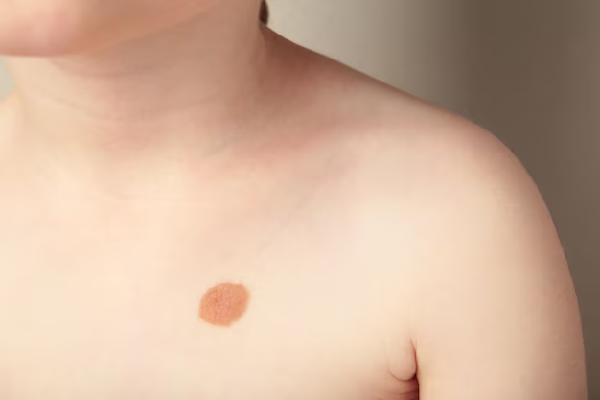 Warts Removal