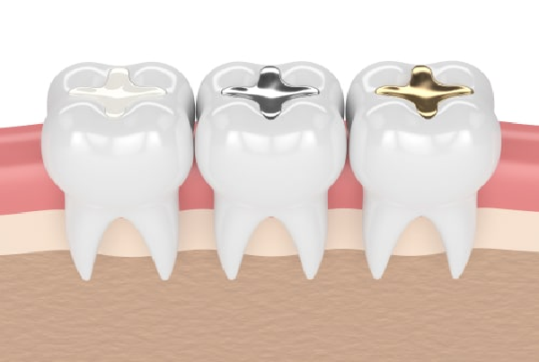 Dental Restorations and Fillings
