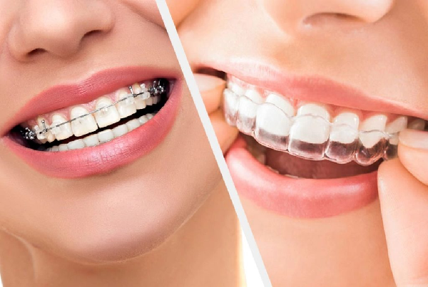 Clear Aligners and Braces